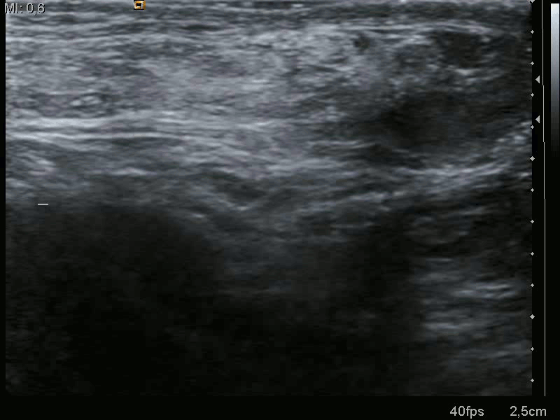Ultrasound image of inguinal hernia. Moving intestines in inguinal canal with respiration.