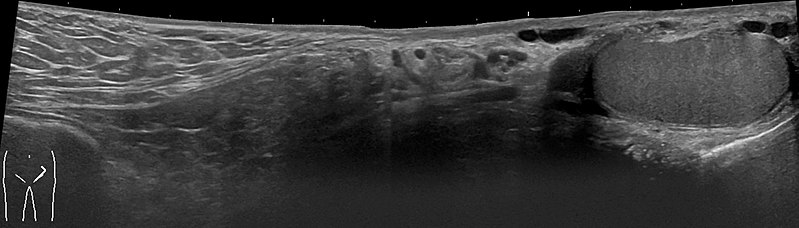 Ultrasound of an indirect hernia containing fat, with testicle seen at right.