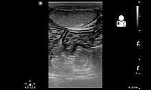 Ultrasound showing an indirect inguinal hernia