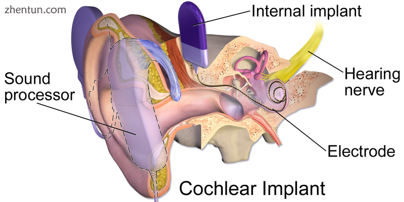 An illustration of a cochlear implant.