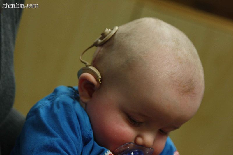 An infant with a cochlear implant.