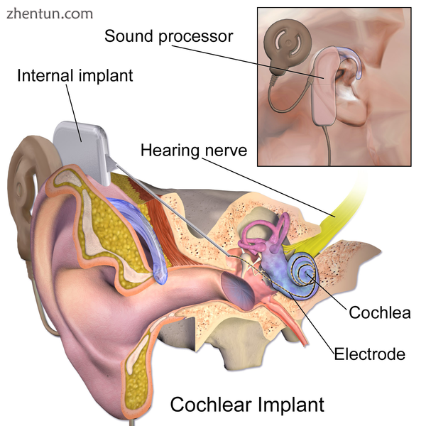 Cochlear implant