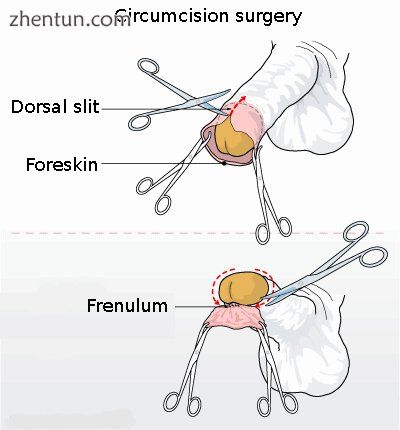 Circumcision surgery with hemostats and scissors