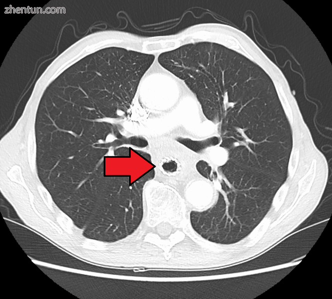 Esophageal stent for esophageal cancer