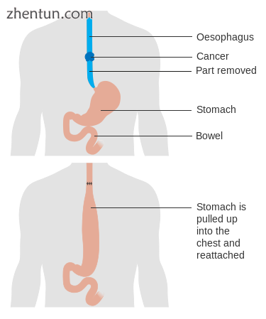 Before and after a total esophagectomy