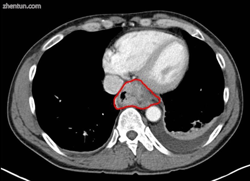 Contrast CT scan showing an esophageal tumor (axial view)