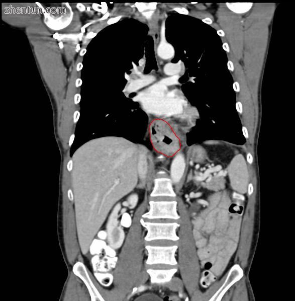 Contrast CT scan showing an esophageal tumor (coronal view)