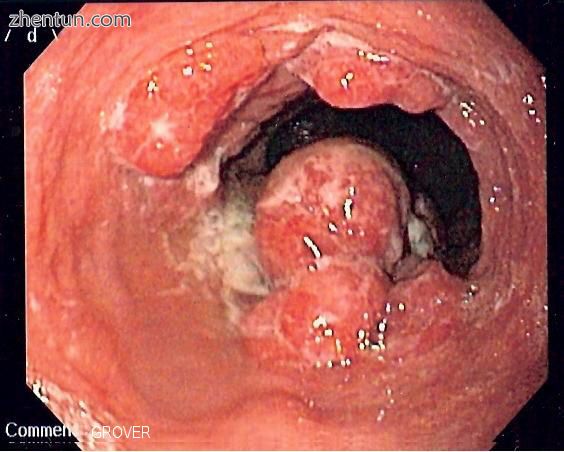 Endoscopic image of an esophageal adenocarcinoma