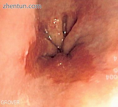 Endoscopic image of Barrett esophagus – a frequent precursor of esophageal adenocarcinoma