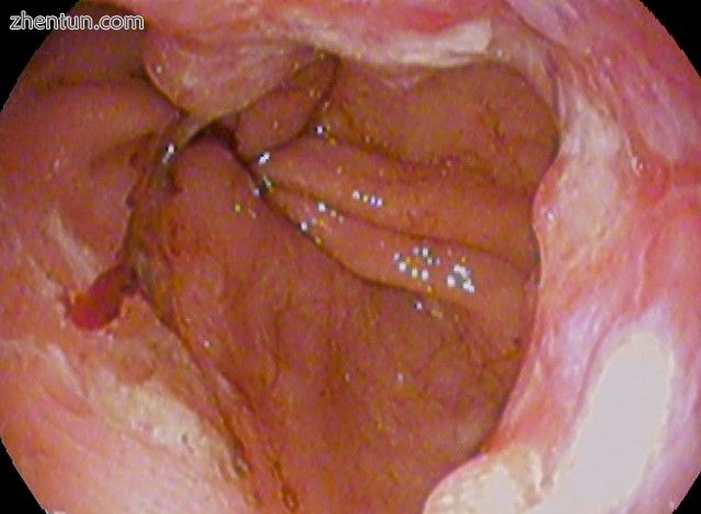 Esophageal cancer (lower part) as a result of Barrettʼs esophagus