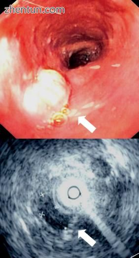 Endoscopy and radial endoscopic ultrasound images of a submucosal tumor in the central portion of th ...
