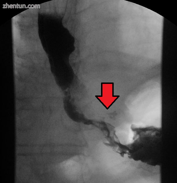 Esophageal cancer as shown by a filling defect during an upper GI series