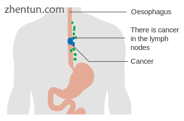 Esophageal cancer with spread to lymph nodes