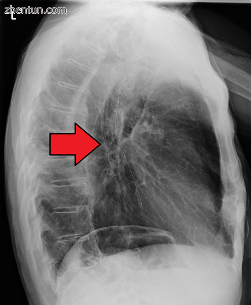 Esophageal stent for esophageal cancer