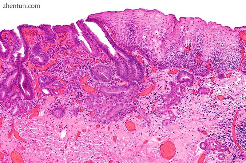 Micrograph showing histopathological appearance of an esophageal adenocarcinoma (dark blue – upper- ...