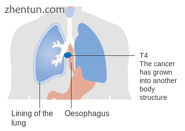 Stage T4 esophageal cancer