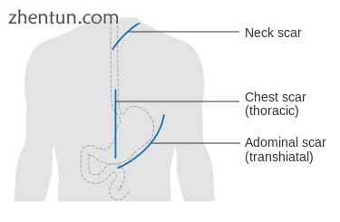 Typical scar lines after the two main methods of surgery