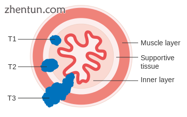 T1, T2, and T3 stages of esophageal cancer