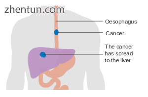 Diagram_showing_oesophageal_cancer_that_has_spread_(M_staging)_CRUK_175.svg.png