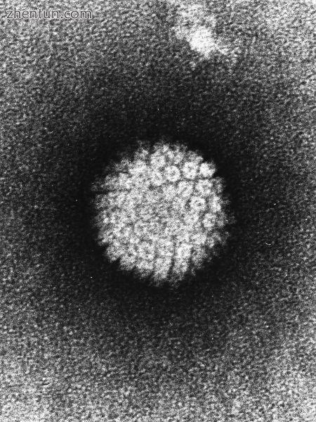 Human papillomavirus infection