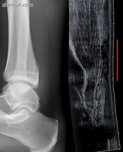 Achilles tendon rupture seen on ultrasound. Note discontinuity over several centimeters (red line).  ...