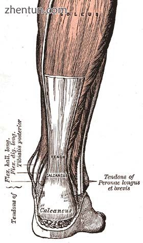 Achilles tendon rupture