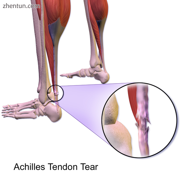 Achilles tendon tear.