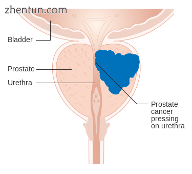 A diagram of prostate cancer pressing on the urethra, which can cause symptoms