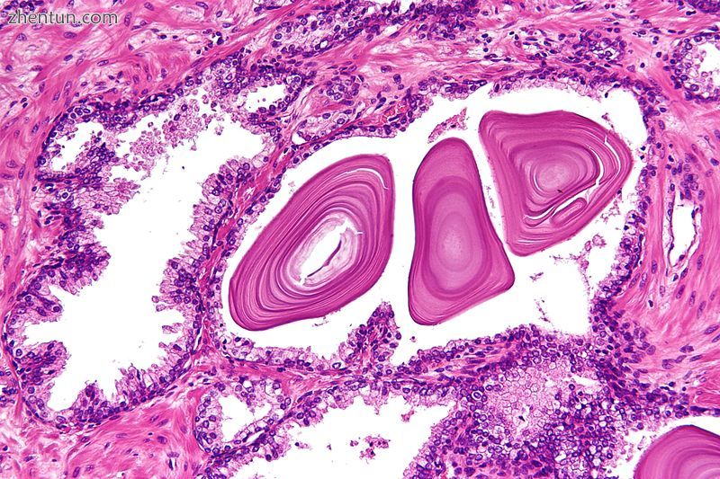 Micrograph of benign prostatic glands with corpora amylacea. H&E stain.