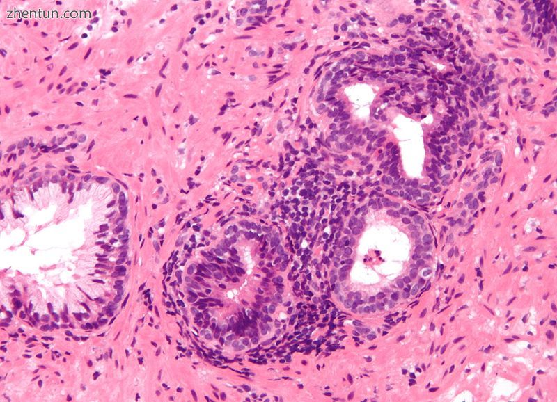 Micrograph showing an inflamed prostate gland, the histologic correlate of prostatitis. A normal non ...