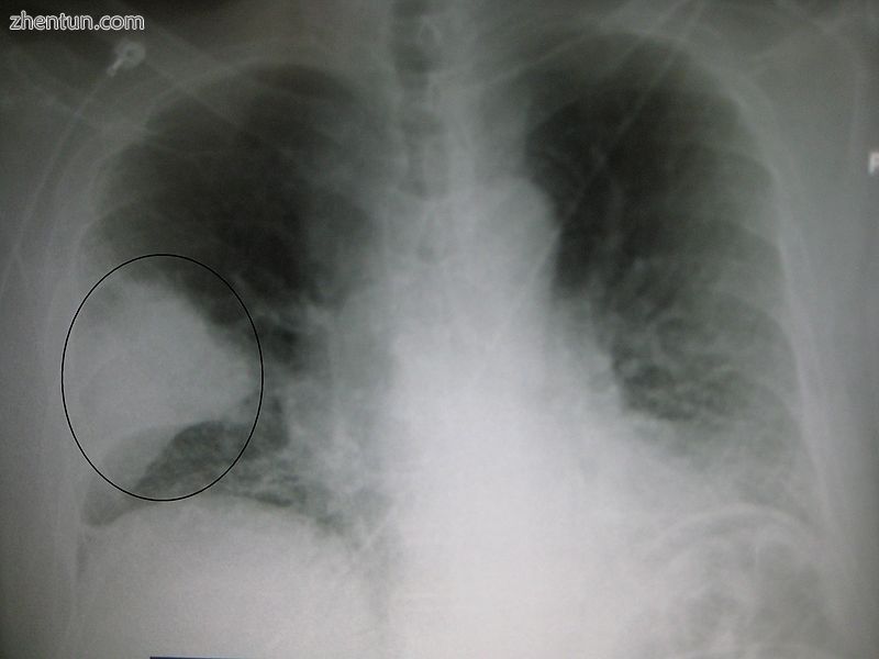A chest X-ray showing a very prominent wedge-shape area of airspace consolidation in the right lung  ...
