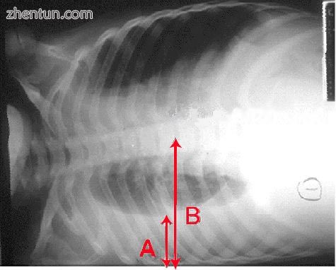A pleural effusion: as seen on chest X-ray. The A arrow indicates fluid layering in the right chest. ...