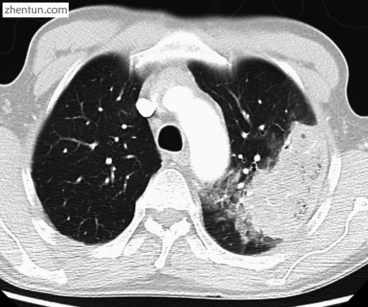 Cavitating pneumonia as seen on CT. Pneumonia due to MRSA.