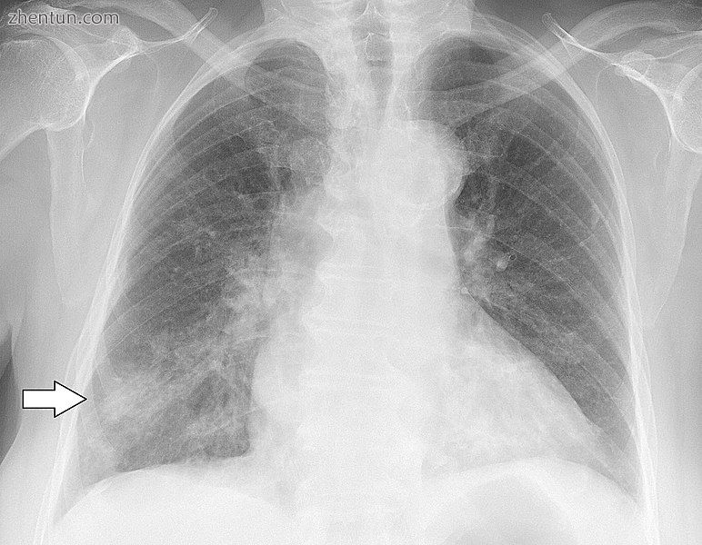 Chest X-ray of a pneumonia caused by influenza and Haemophilus influenzae. Right lower lobe consolid ...
