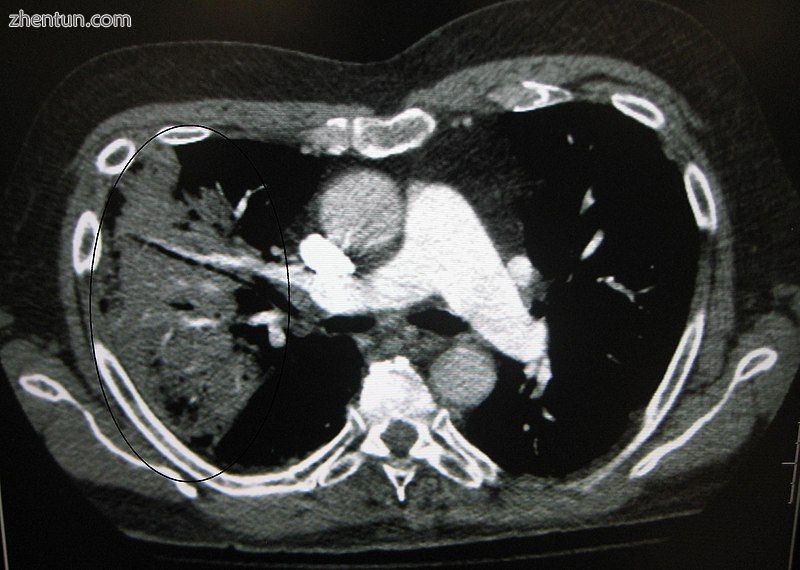 CT of the chest demonstrating right-side pneumonia (left side of the image)