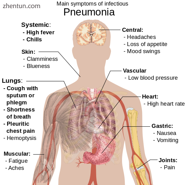 Main symptoms of infectious pneumonia