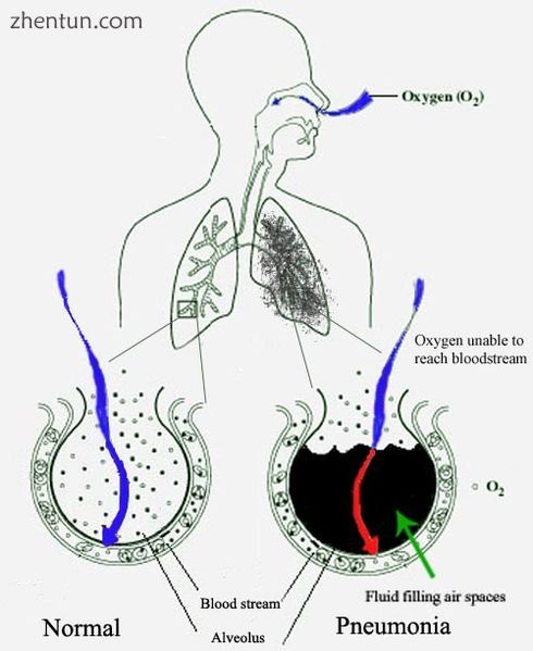 Pneumonia fills the lung's alveoli with fluid, hindering oxygenation. The alveolus on the left is no ...