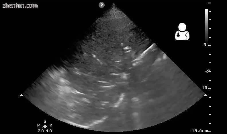 Pneumonia seen by ultrasound[62]