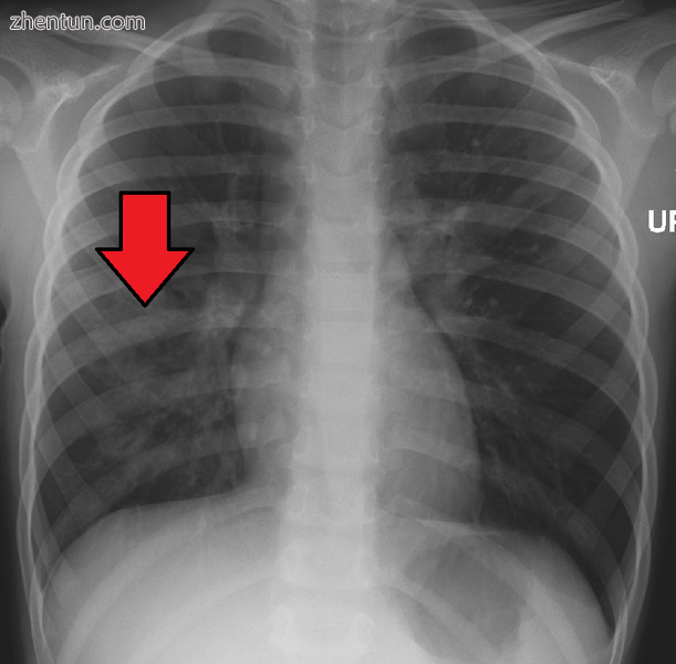 Right middle lobe pneumonia in a child as seen on plain X ray
