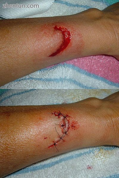 A wound before and after suture closure. The closure incorporates five simple interrupted sutures an ...