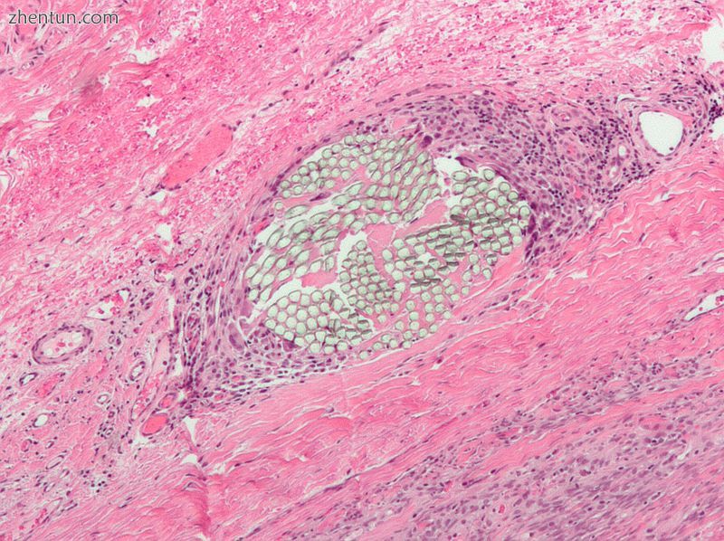 Micrograph of a H&E stained tissue section showing a non-absorbable multi-filament surgical suture ...