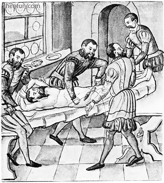 Sewing wound after herniotomy, 1559