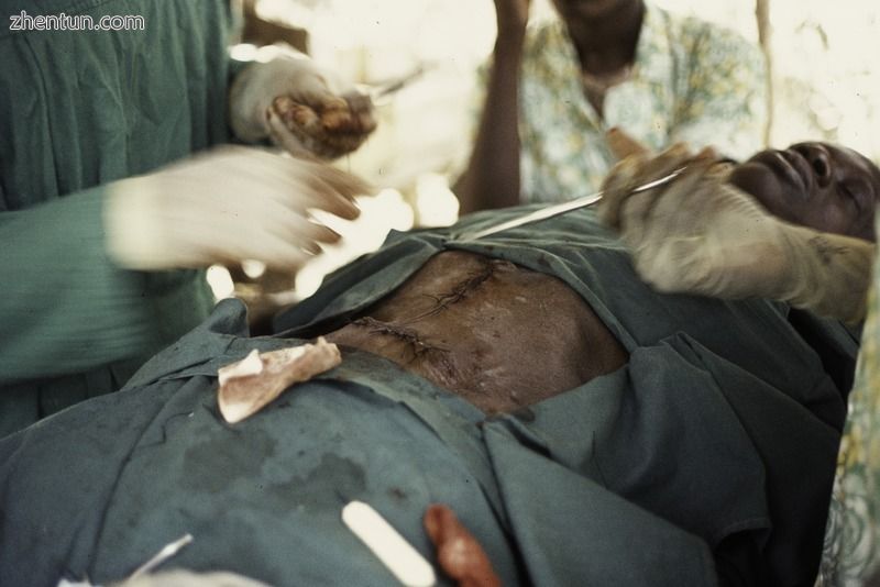 Suturing two operation wounds with eleven simple stitches by a Cuban doctor. Sara, Guinea-Bissau, 19 ...
