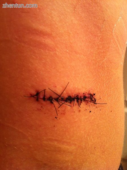 Twelve nonabsorbable sutures in a person's lower back.