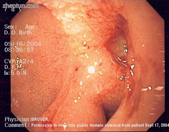 Endoscopic image of a posterior wall duodenal ulcer with a clean base, which is a common cause of up ...