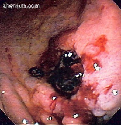 Gastric ulcer in antrum of stomach with overlying clot. Pathology was consistent with gastric lympho ...
