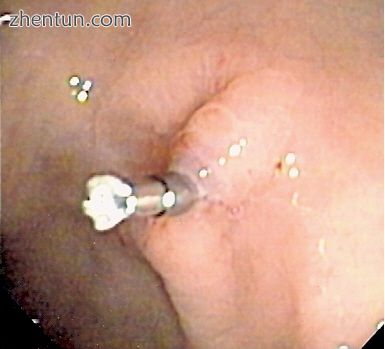 The above ulcer seen after endoscopic clipping