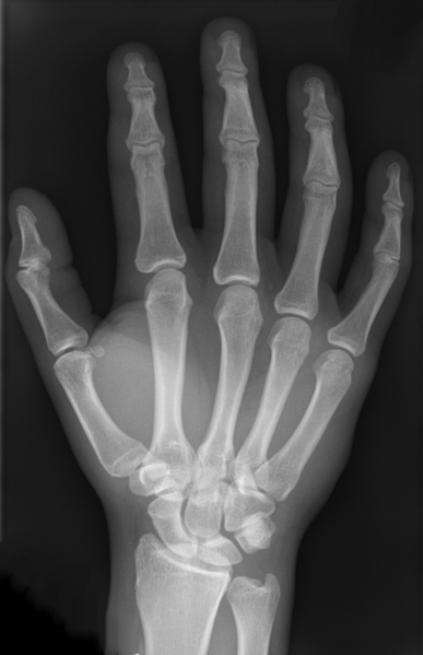 X-ray of human hand