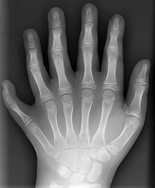 X-ray of the left hand of a ten-year-old boy with polydactyly.