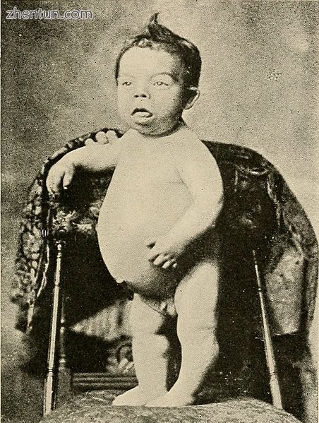 Child affected by cretinism, associated with a lack of iodine.